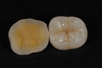 Figure  27  Restorations after final glaze and divesting. Notice the integrity of the inner side of the restoration and color developed from within.