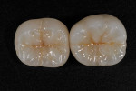 Figure  28  The natural resemblance to the color scheme of the prepared tooth.