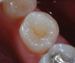 Figure  30  The occlusal layering materials used for this specimen are described in the article. Photo courtesy of R. Alpert, DDS.
