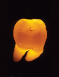 Figure  31  When transilluminated, the restoration becomes indistinguishable from the natural tooth.