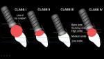 Figure 7  Diagrammatic representation of the classification system of patients for esthetic fixed implant-supported prosthesis showing all four classes. Note that prosthetic space decreases as one proceeds from Class I to Class IV.