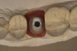 Figure  11   Occlusal view of the milled abutment in place on the model.