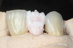Figure  4  The same IPS e.max Opal Effect 3 powder was applied to increase light in the incisal third and the brightness of the line angles and mamelons.