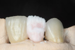 Figure  5  The incisal edge was covered with IPS e.max Transpa Clear Enamel.