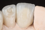 Figure  13  From the lingual aspect, the difference between the materials used for the IPS InLine One PFM crown and the IPS e.max lithium disilicate all-ceramic crown is apparent in the margins; however, the overall esthetics of the crowns match.