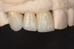 Figure  15  View of the case completed as a combination of IPS InLine PFM restorations (teeth No. 6 and No. 8) and one IPS e.max lithium disilicate all-ceramic crown (tooth No. 7).
