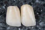 Figure  18  Side-by-side facial view of the InLine One PFM and IPS e.max lithium disilicate all-ceramic crowns; note the harmonious and consistent chroma and translucency.
