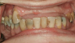 Figure 10  Pretreatment frontal view of teeth and ridges of a Class I patient.