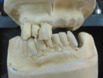 Figure  3  Since there were only three teeth to be extracted on the left side, pre-prosthetic model surgery was performed by removing and socketing each tooth. The ridge was reduced labially by 1 mm to 2 mm, depending on length of roots.