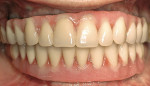 Figure 11  Posttreatment frontal view of teeth and gingiva-colored prosthetic material.