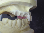 Figure  7  Pre-prosthetic cast surgery was performed for teeth Nos. 5 through 8 by removing and preparing a socket to set each denture tooth. The labial ridge as seen was reduced by 1.5 mm to allow for lost tissue and bone during surgery and to provi