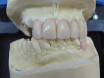 Figure  8  The denture teeth on the patient’s right side were contoured and set in each socket.