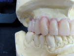 Figure  9  Posterior teeth were set on the patient’s right side, and a modified cross-bite compromised situation was seen in the first and second molar areas.