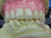(21.) The provisional restorations show the vertical and horizontal changes in the incisal edge position.