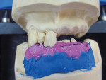 Figure  11  To verify proper placement of anterior teeth according to the clinician&’s instructions, an incisal index was made before pre-prosthetic cast surgery. The index with teeth was on the patient’s right side, and the negative space