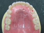 Figure  13  The occlusal and palatal view of the completed tooth arrangement and wax contouring with a duplicate palate stent (0.020 vacuum form) waxed in place. Occlusal contacts verified before investing as marked in red.