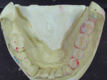 Figure  14  The occlusal view of the mandibular posterior contacts marked in red.
