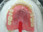 Figure  15   The immediate complete denture prosthetic was invested in the first half and sprued for injection mold processing.