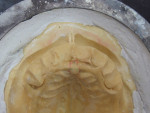 Figure  17  The positive mold with master cast was cleaned and the tooth sockets were smoothed with interproximal ridges removed.