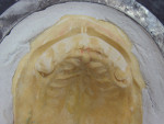 Figure  18  The ridge where the teeth had been extracted during pre-prosthetic cast surgery was smoothed with a knife and sandpaper before painting separator was applied for injection processing.