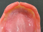 Figure  19  After the complete immediate denture was processed, de-vested, and remounted to verify occlusal contacts, the master cast was carefully removed and intaglio exposed. The labial undercut on peripheral border was definitely overextended and