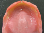 Figure  21  After trimming and polishing the overextended labial undercut and peripheral borders, the denture can be seated after surgical extractions.