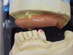 Figure 22  After the immediate complete denture was polished, a VPS/addition reaction silicone index was made of the intaglio surface, which represented the pre-prosthetic surgical ridge reduction.