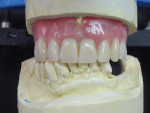 Figure  24  The final labial view of the complete immediate denture prosthesis showed anterior incisal placement and posterior tooth position in relation to the mandibular teeth and edentulous ridge on the patient