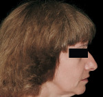 Figure 13  Posttreatment profile of the same patient emphasizing the contribution of the gingiva-colored prosthetic material on lip support.