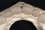 Figure  6   A 0.5-mm facial reduction was accomplished using a KOMET K6974 220 centered diamond disc to bevel down approximately one-half of the restoration.