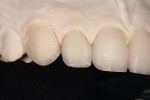 Figure  8  Using universal stains, both high and low value details that are typically found internally in a natural tooth were emulated.