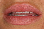 Figure  15 A final postoperative view of the patient’ss lips in repose.