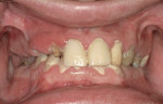 Figure 16  Pretreatment frontal view of teeth and ridges of a Class II patient.