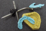 Figure  6  The case was facebow-mounted on a Denar Combi articulator and set up using the principles of replicating the anterior esthetics with lingualized posterior occlusion.