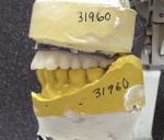 Figure  7  Lingualized occlusion was recommended for the restoration of this full-arch dental implant case.