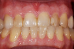 Figure  1   Pre-operatively, the patient was unhappy with his tooth color and shape.