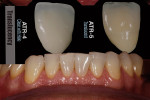 Figure 2  Anterior translucency was also checked in the mouth.
