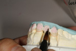 Figure  12  Dentin and enamel porcelain build-up was applied using GC ZR-FS porcelain.
