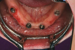 Figure 2  Retractedview of the patient after implantplacement.
