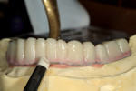 Figure 24  The opacious dentinapplication was followed by alayer of A2 dentin.