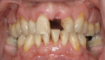 Figure 22  Pretreatment frontal view of teeth and ridges of a Class III patient with a diagnosis of generalized external root resorption.
