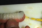 Figure 27  Furthermodification of the dentureteeth was accomplished withorange stain to help createmamelon effects.