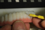 Figure 28  Furthermodification of the dentureteeth was accomplished withorange stain to help createmamelon effects.