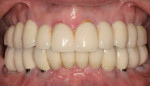 Figure 23  Posttreatment frontal view of teeth of the same patient.