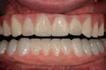 Figure 37  Final restoration inthe mouth.