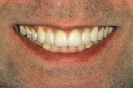 Figure 5  Postoperative views (smile and full face) show that the correction of the functional and esthetic problemsresults in an esthetically pleasing smile. Restorations by Shoji Suruga, CDT; at Bay View Dental Laboratory.