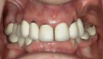 Figure 28  Pretreatment frontal view of teeth and ridges of a Class IV patient.