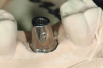 Figure 7  The definitive abutment in the master cast.