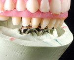 Figure 1B  Adequate restorative space is essential for the components of this bar and implant-supported overdenture. During fabrication, the laboratory fabricates the substructure according to the desired tooth position. Attachments are placed allowi