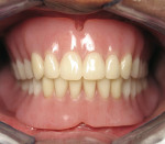 Figure 1D  Adequate restorative space is essential for the components of this bar and implant-supported overdenture. During fabrication, the laboratory fabricates the substructure according to the desired tooth position. Attachments are placed allowi
